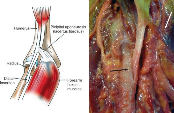 Fig. 62.2, Anatomy of the distal biceps tendon. The black arrow indicates the insertion of the distal biceps tendon; the white arrow indicates the bicipital aponeurosis.