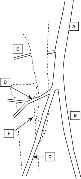 Fig. 62.3, Vascular anatomy surrounding the distal biceps insertion. Proximal radius and biceps tendon are depicted by dotted lines. A, Brachial artery; B, ulnar artery; C, radial artery; D, radial recurrent artery; E, dorsal radial recurrent artery; F, proximal most aspect of radial tuberosity.