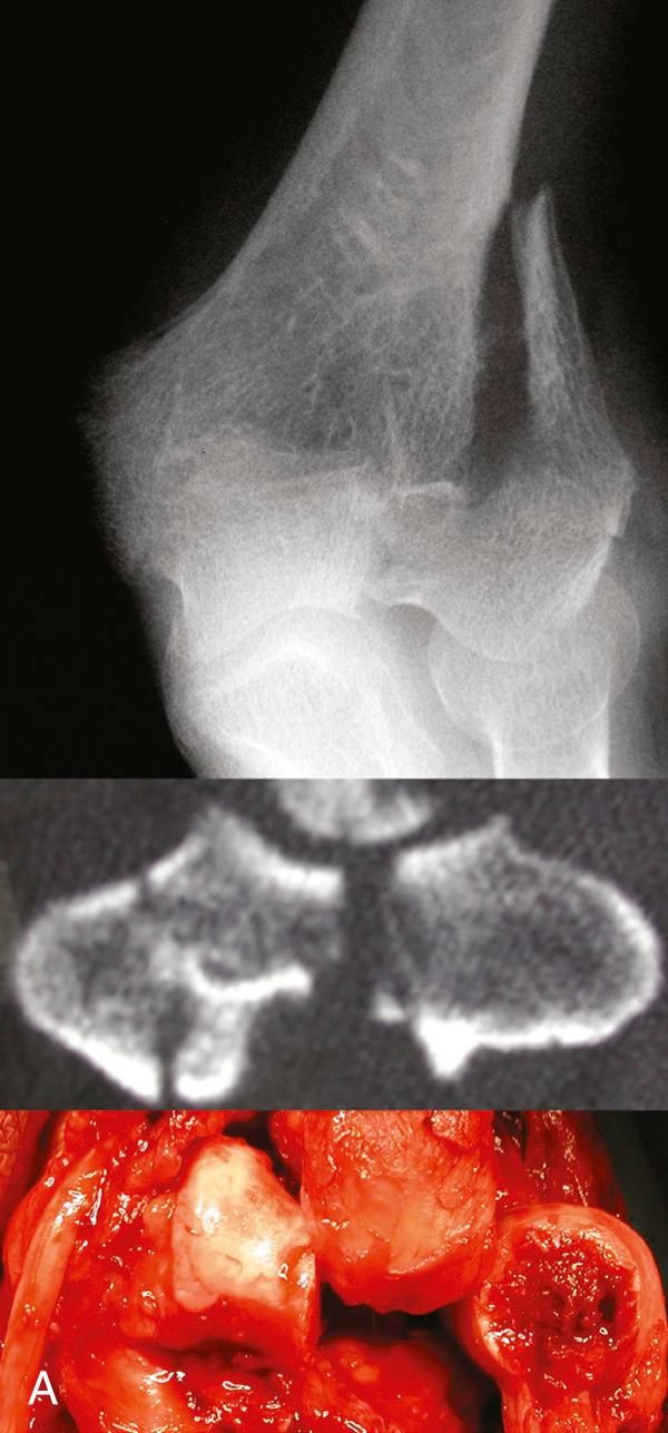 FIG 92.1, (A) Distal humeral fracture showing, with a radiograph, CT scan, and intraoperative findings, the extent of comminution and osteopenic state of the bone. (B–E) Low osteoporotic transcondylar fractures have little bone of quality for fixation. This is an example of such a fracture that is malrotated when immobilized in a plaster cast.