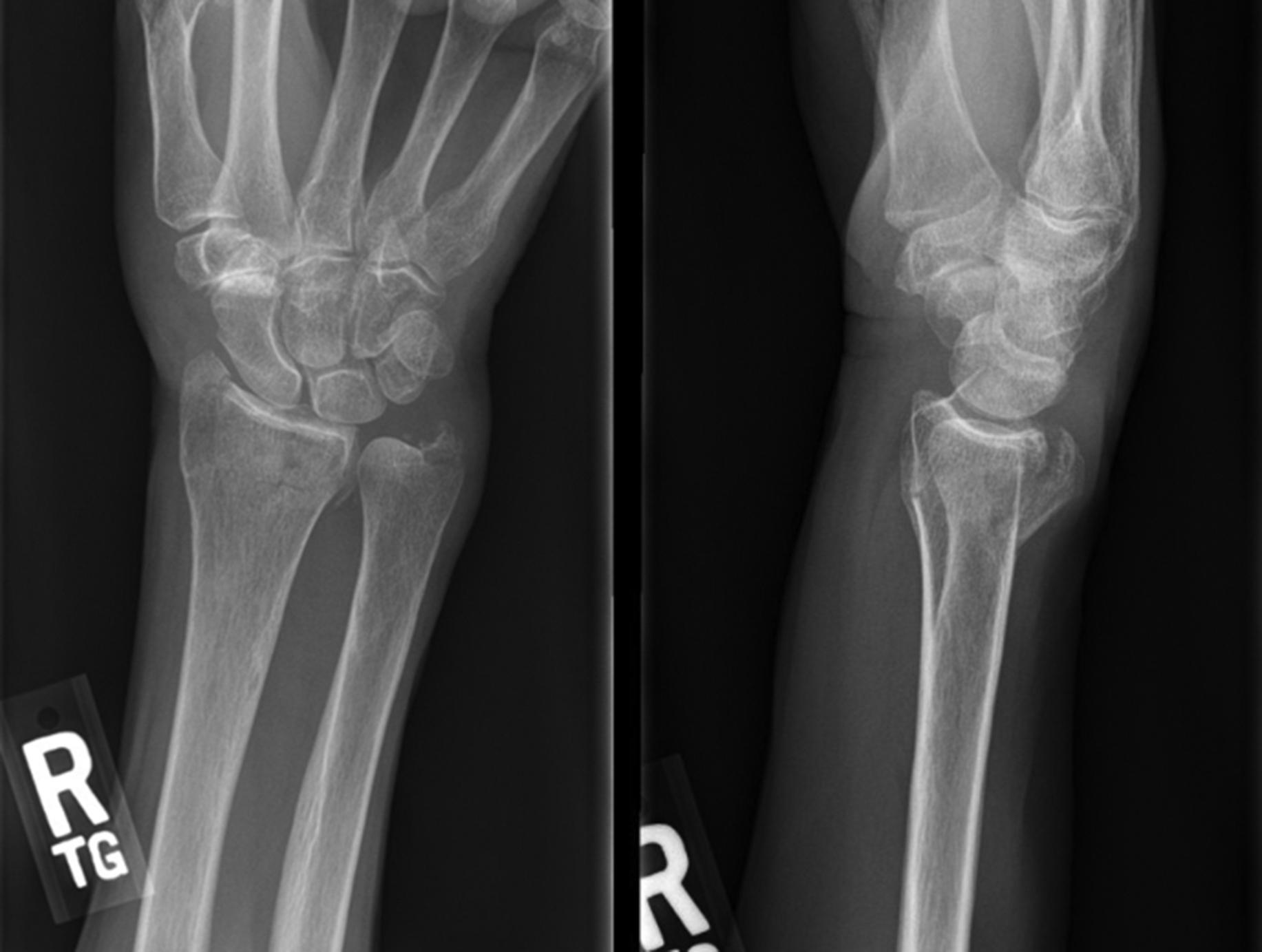 Fig. 1, Initial fracture demonstrating minimal displacement.