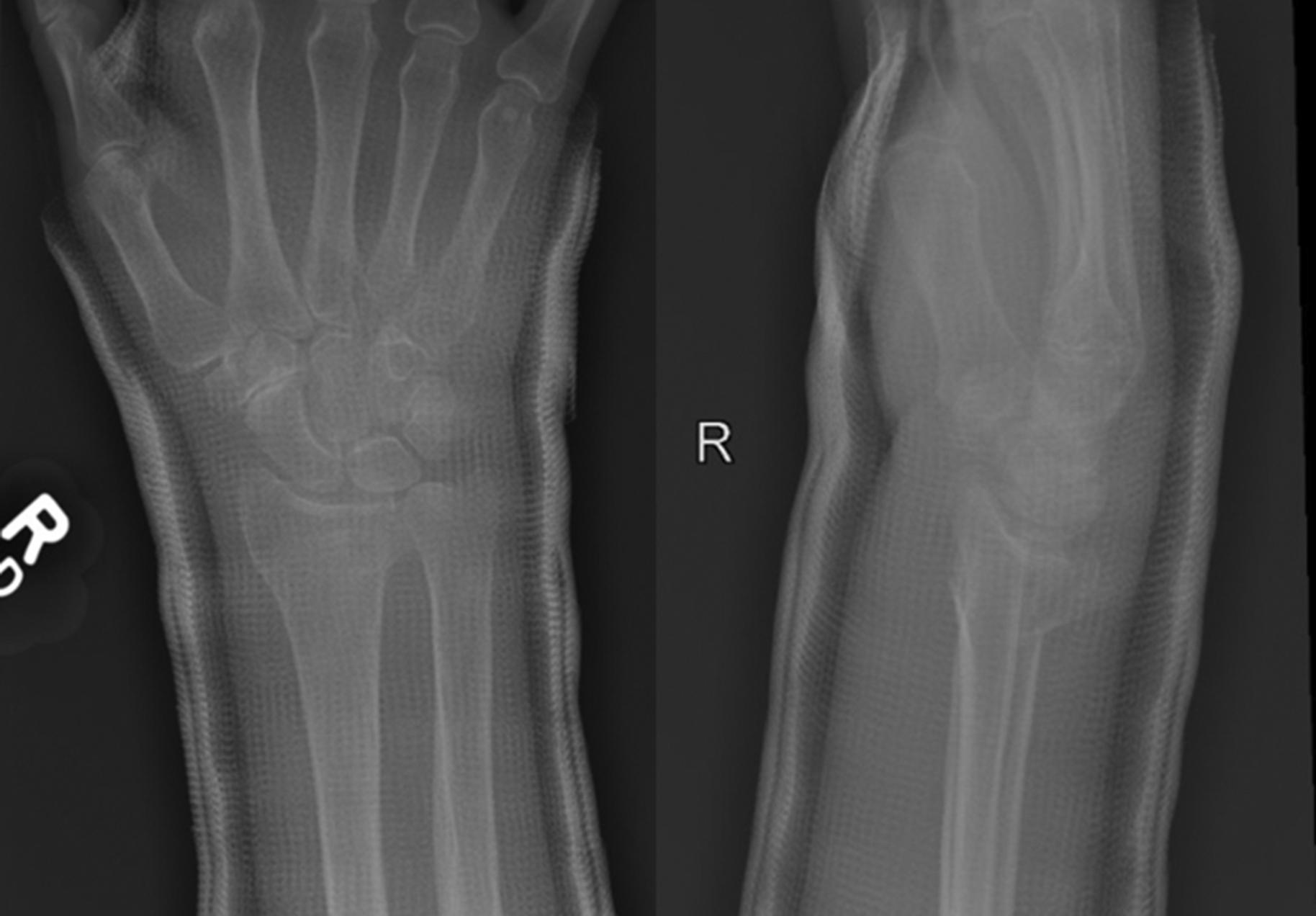 Fig. 2, Fracture at 1 week follow up demonstrating loss of radial length and dorsal angulation.