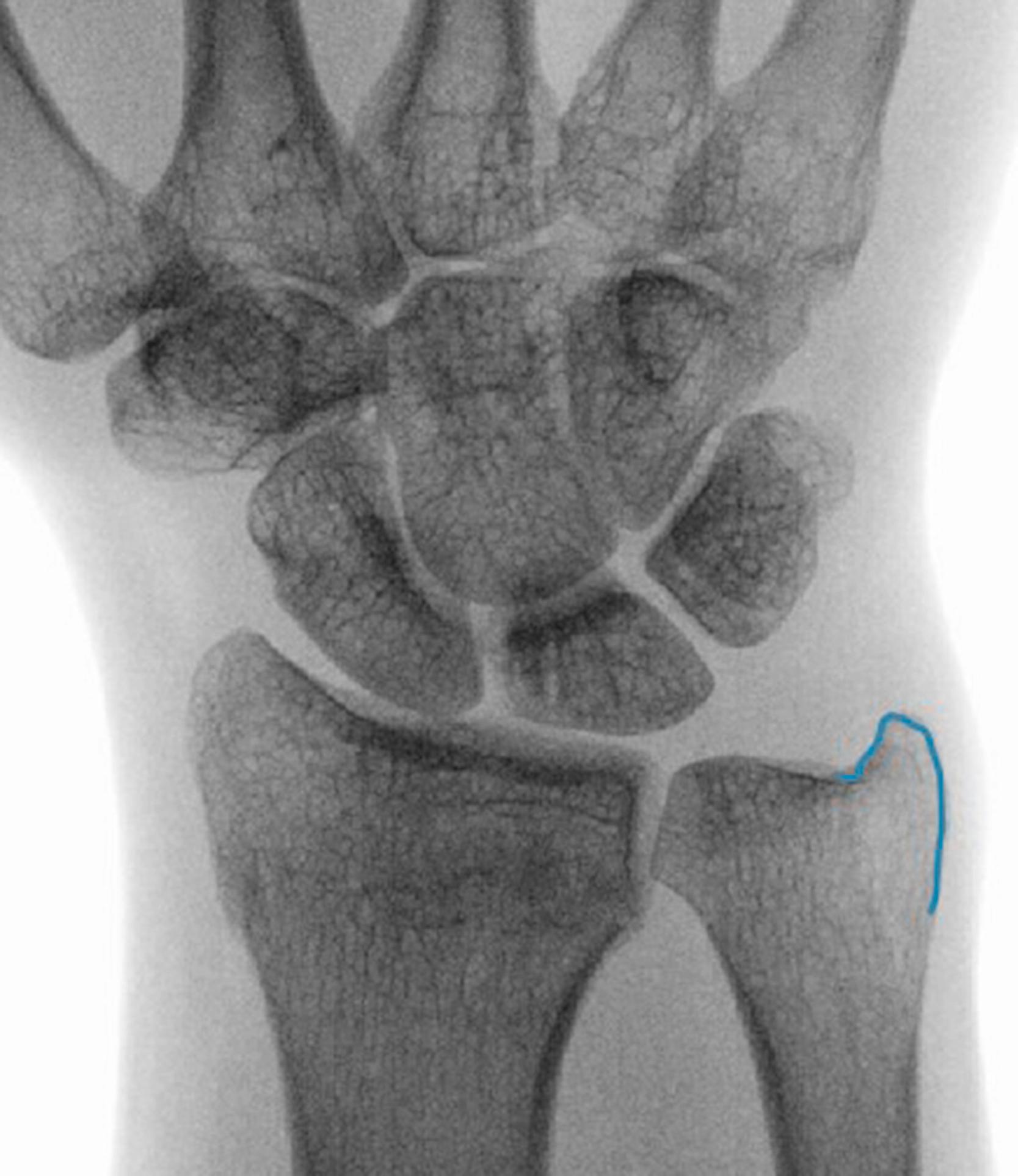 Fig. 60.2, Neutral rotation posteroanterior X-ray of wrist with ulnar styloid (blue outline) at ulnar border of ulna.