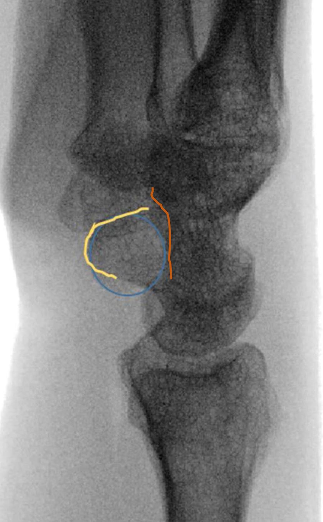 Fig. 60.3, True lateral X-ray of wrist with distal pole of scaphoid (yellow outline) just volar to pisiform (blue outline) which is volar to the capitate (orange outline) .