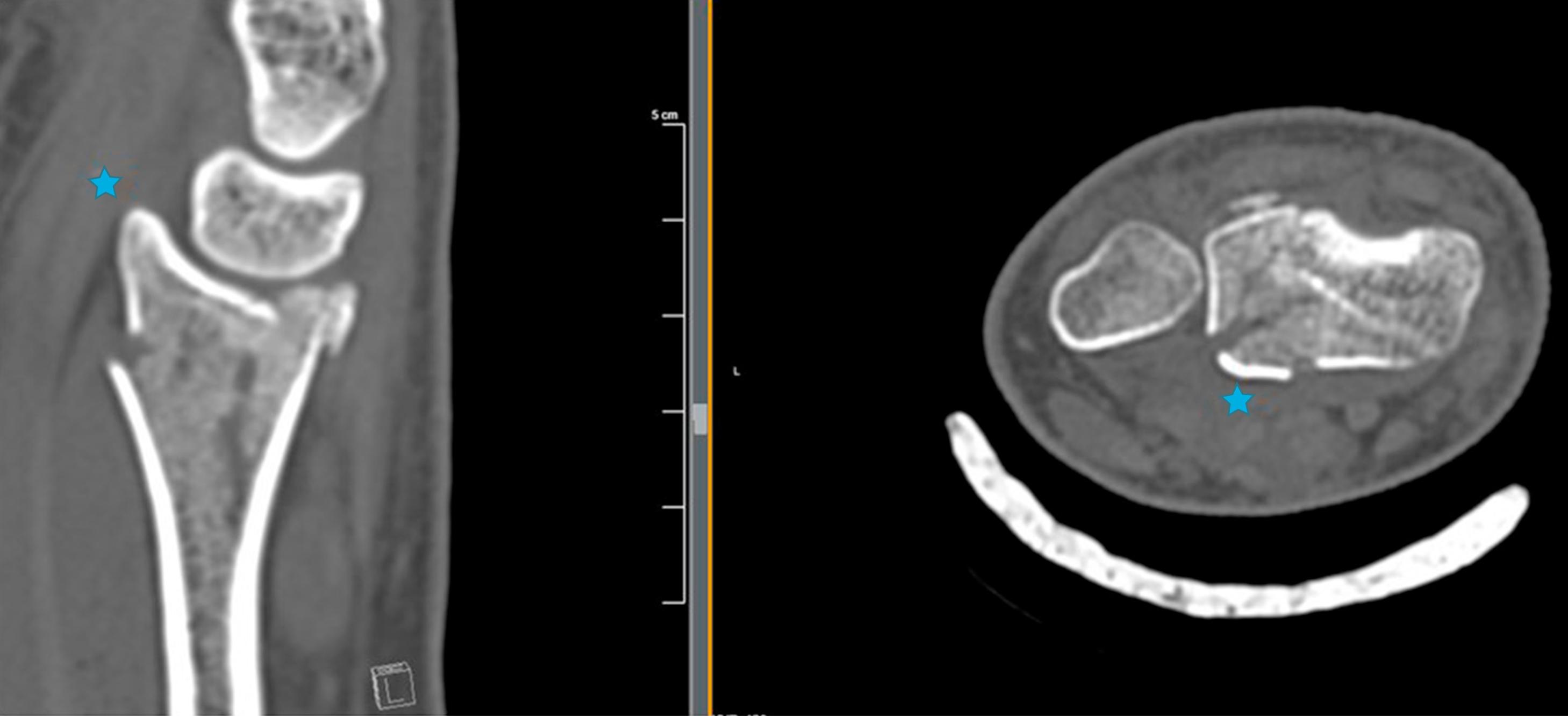 Fig. 60.4, Sagittal and axial computed tomography cuts of distal radius fracture demonstrating the exact size of volar lunate facet fracture (star) .