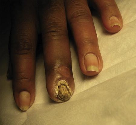 Figure 67-1, Digital gangrene in a patient with a brachiocephalic AV fistula and steal syndrome.
