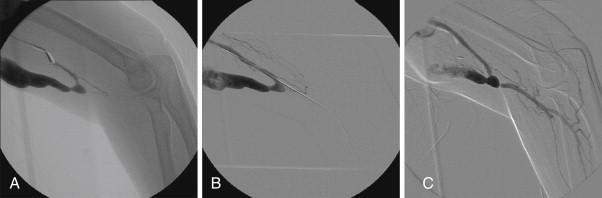 Figure 67-2, A , Angiogram of a brachial artery demonstrating flow through the fistula but without distal arterial flow. B , An angiogram of the brachial artery with passage of a wire into the radial artery. C , Angiography with manual compression of the fistula results in flow into distal vessels.