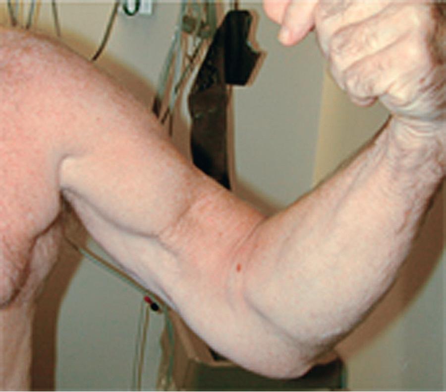 Fig. 56.1, Left upper extremity in a patient with chronic distal biceps rupture demonstrating proximal retraction of the muscle belly and resultant “Popeye” sign.