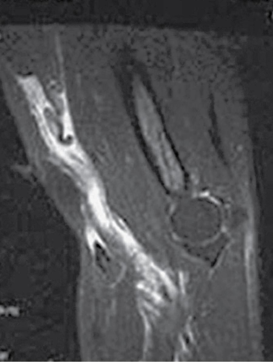 Fig. 56.2, Sagittal T2-weighted magnetic resonance image demonstrating complete rupture of the distal biceps tendon with proximal retraction and significant fluid within the biceps sheath.