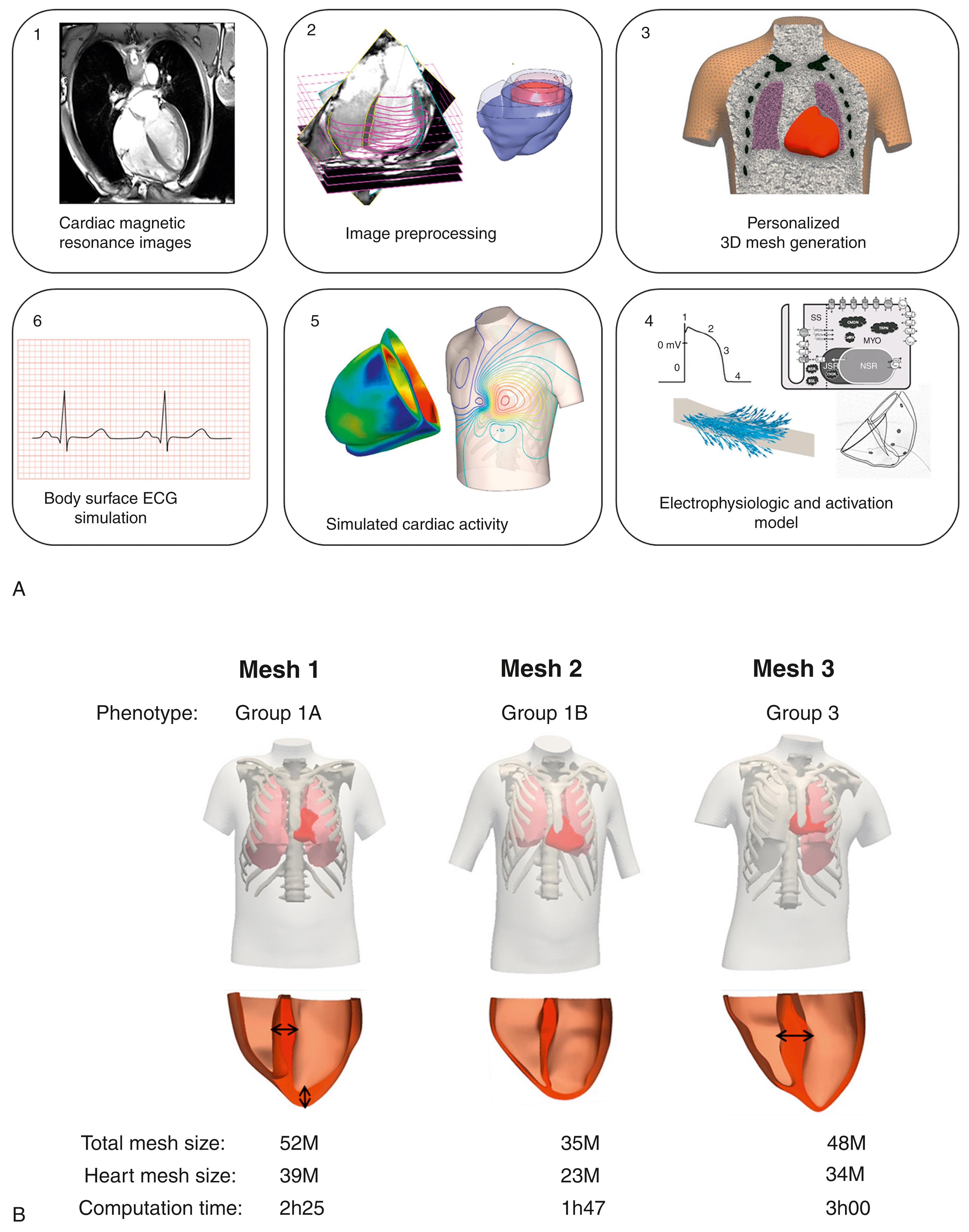 Fig. 34.2, (A) Summary of the simulation pipeline: cardiac magnetic resonance images (1) are preprocessed (2) to generate a personalized three-dimensional (3D) volumetric mesh (3) . An electrophysiologic model is then defined (4) and the cardiac electrical activity can be simulated (5) and the electrocardiogram (ECG) recorded (6) . (B) Characteristics of the three individual meshes built in this work.