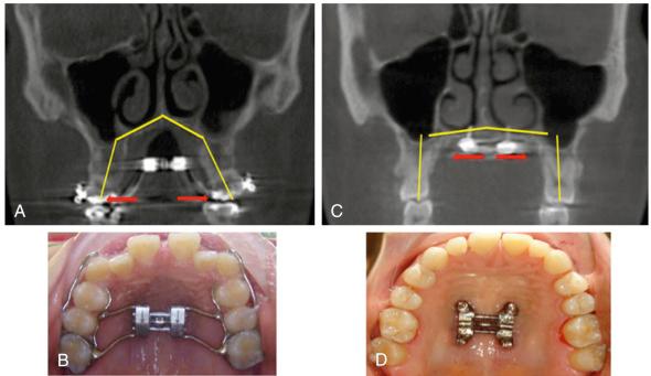FIG. 59.1, Comparison of tooth- versus bone-anchored expanders.