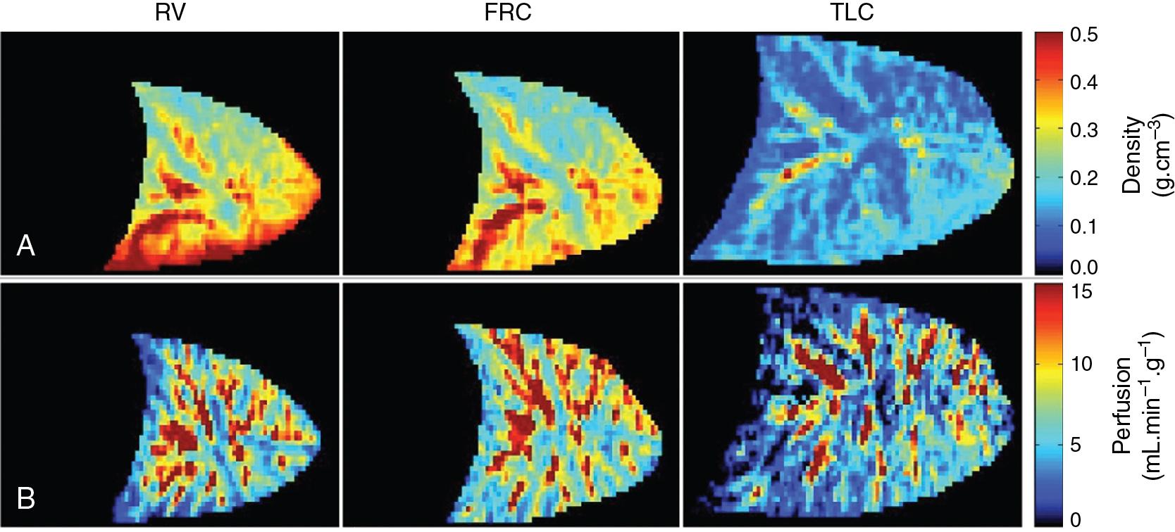 • Fig. 7.5, Magnetic resonance images showing regional variation in lung density and perfusion in a healthy supine subject at different lung volumes. Figures show a single sagittal slice through the right lung. (A) Lung density is increased in dependent regions because of gravity, the variation being maximal at residual volume, intermediate at functional residual capacity, and lung density becomes almost uniform at total lung capacity. (B) Regional lung perfusion per gram of lung tissue is mostly unaffected by gravity at all lung volumes, being more influenced by distance from the hilum. FRC, Functional residual capacity; TLC, total lung capacity; RV, residual volume.