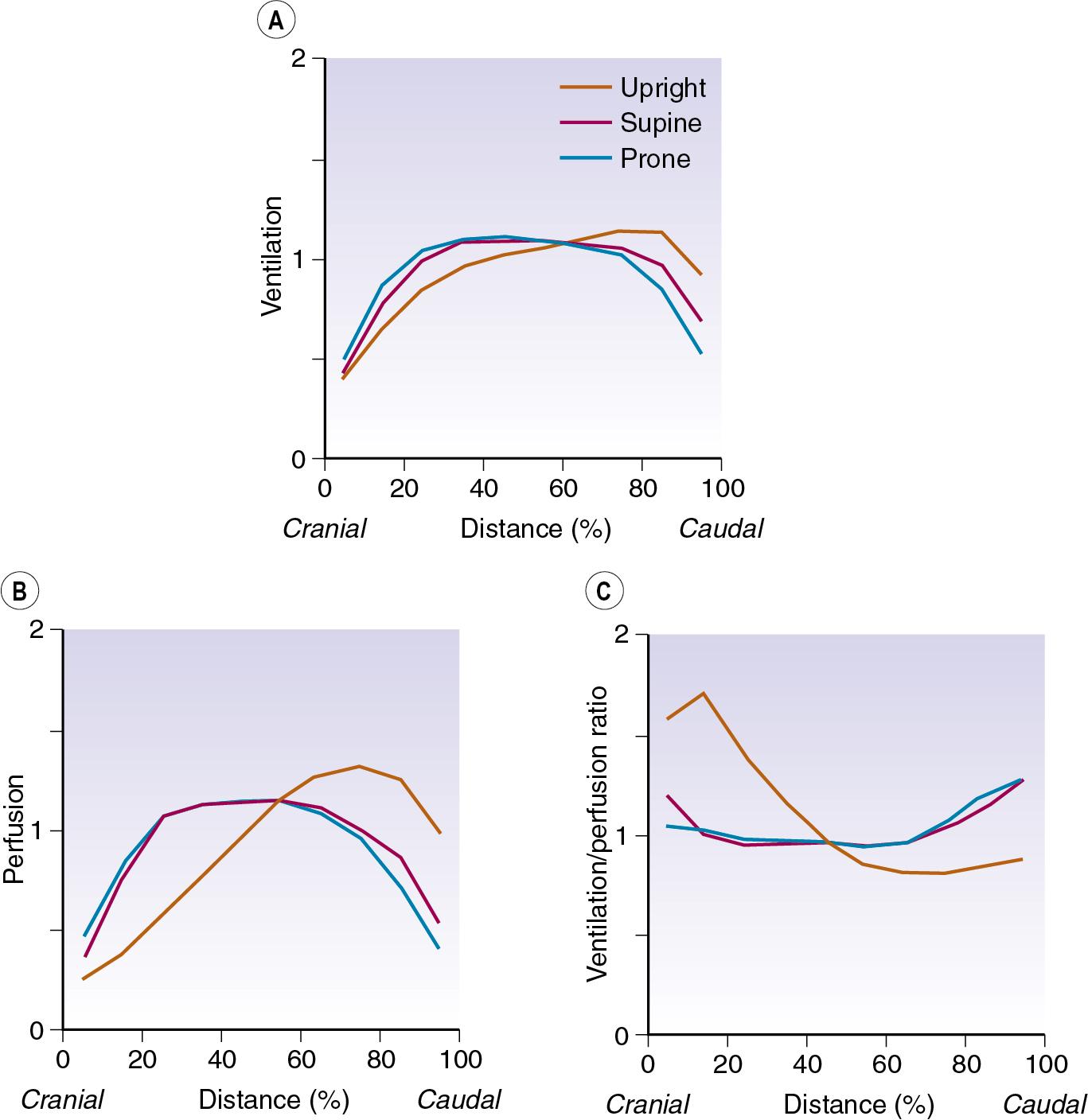 • Fig. 7.7, Measurement of ventilation/perfusion relationships in healthy volunteers breathing at normal lung volume using single-photon emission computed tomography (page 106). (A) Ventilation ( ), (B) perfusion ( ) and (C) ratios. In each case, the lung has been divided into 10 sections in the cranial to caudal direction. Ventilation and perfusion refer to the ventilation in the region under consideration relative to the ventilation of the whole lung. Note the excellent matching of ventilation and perfusion in the supine ( red ) and prone ( blue ) positions, with less good matching when upright ( yellow ), with perfusion increasing more than ventilation in the dependent lung regions.