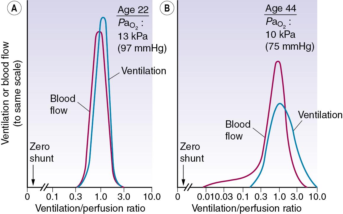 • Fig. 7.8, The distribution of ventilation and blood flow in relation to ventilation/perfusion ( ) ratios in two normal subjects. (A) A male aged 22 years with typical narrow spread and no measurable intrapulmonary shunt or alveolar dead space. (B) The wider spread of ratios in a male aged 44 years. There is still no measurable intrapulmonary shunt or alveolar dead space, but the appreciable distribution of blood flow to underperfused alveoli is sufficient to reduce the arterial P o 2 to 10 kPa (75 mmHg) while breathing air.