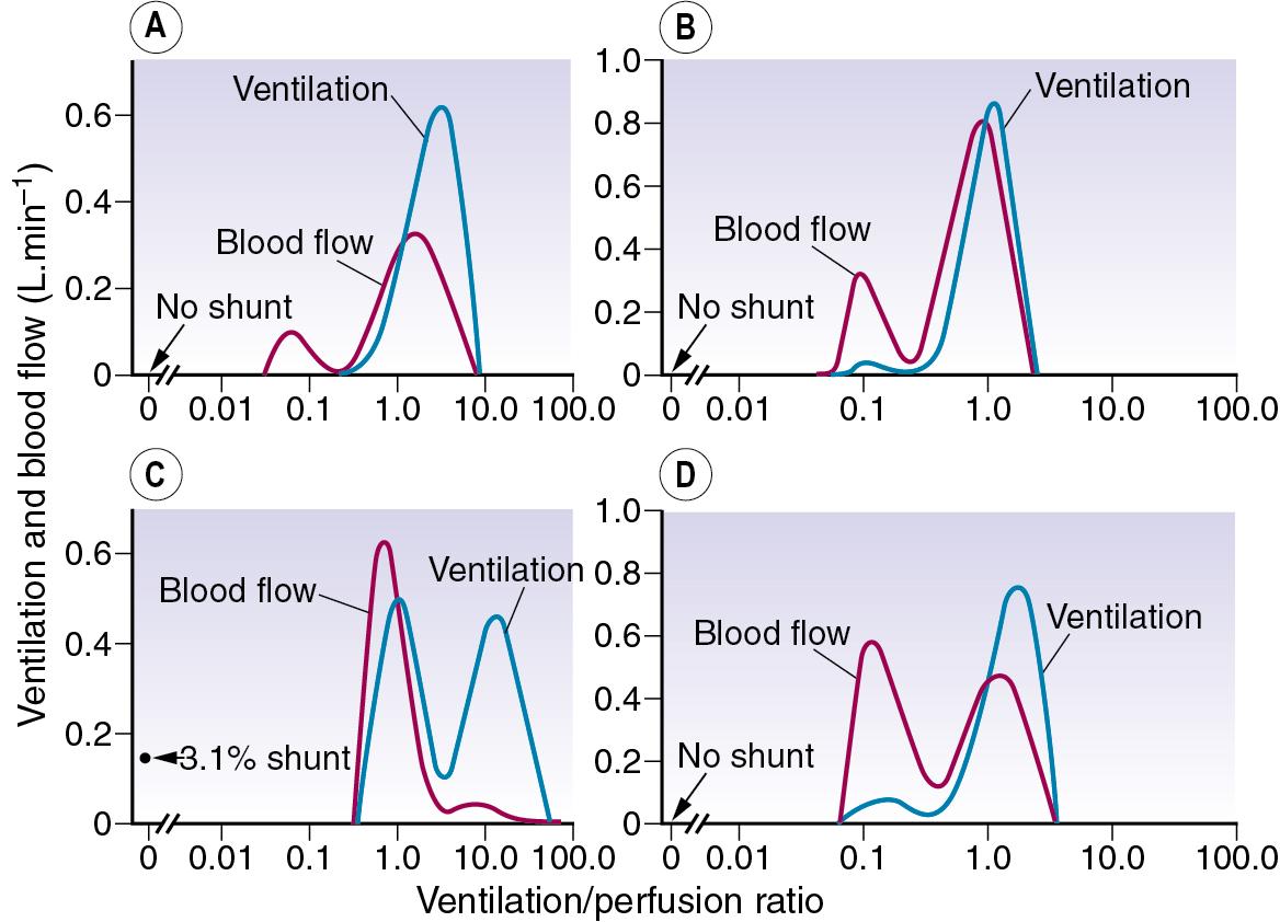 • Fig. 7.9, Examples of abnormal patterns of maldistribution of ventilation and perfusion, to be compared with the normal curves in Figure 7.8 . (A) Chronic obstructive pulmonary disease, the blood flow to units of very low ventilation/perfusion ratio would cause arterial hypoxaemia and simulate a shunt. (B) Asthma, with a more pronounced bimodal distribution of blood flow than the patient shown in (A) . (C) Bimodal distribution of ventilation seen in a 60-year-old patient with chronic obstructive pulmonary disease, predominantly emphysema. A similar pattern is seen after pulmonary embolism. (D) Pronounced bimodal distribution of perfusion after a bronchodilator was administered to the patient shown in (B) .