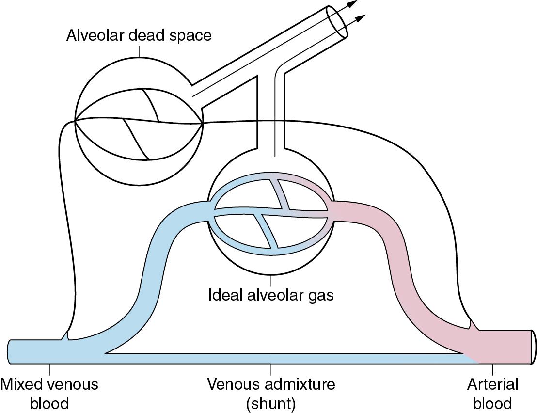 • Fig. 7.10, Three-compartment (Riley) model of gas exchange. The lung is imagined to consist of three functional units comprising alveolar dead space, ideal alveoli and venous admixture (shunt). Gas exchange occurs only in the ideal alveoli. The measured alveolar dead space consists of true alveolar dead space together with a component caused by ventilation/perfusion ( ) scatter. The measured venous admixture consists of true venous admixture (shunt) together with a component caused by scatter. Note that ideal alveolar gas is exhaled contaminated with alveolar dead space gas, so it is not possible to sample ideal alveolar gas.