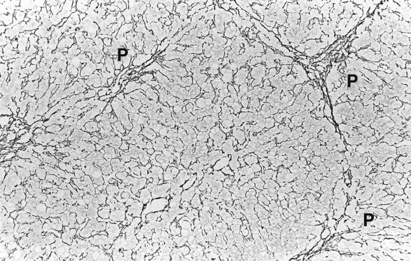 Fig. 14.1, Wilson’s disease.