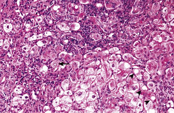 Fig. 14.2, Wilson’s disease.