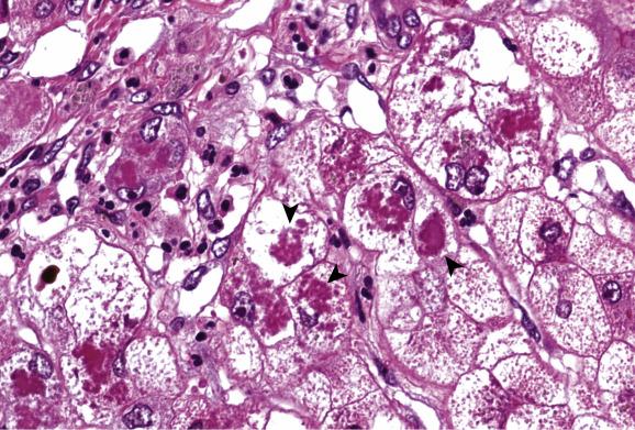 Fig. 14.3, Wilson’s disease.