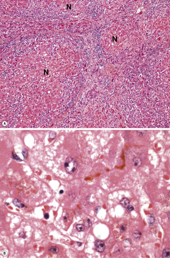 Fig. 14.4, Fulminant liver failure in Wilson’s disease.