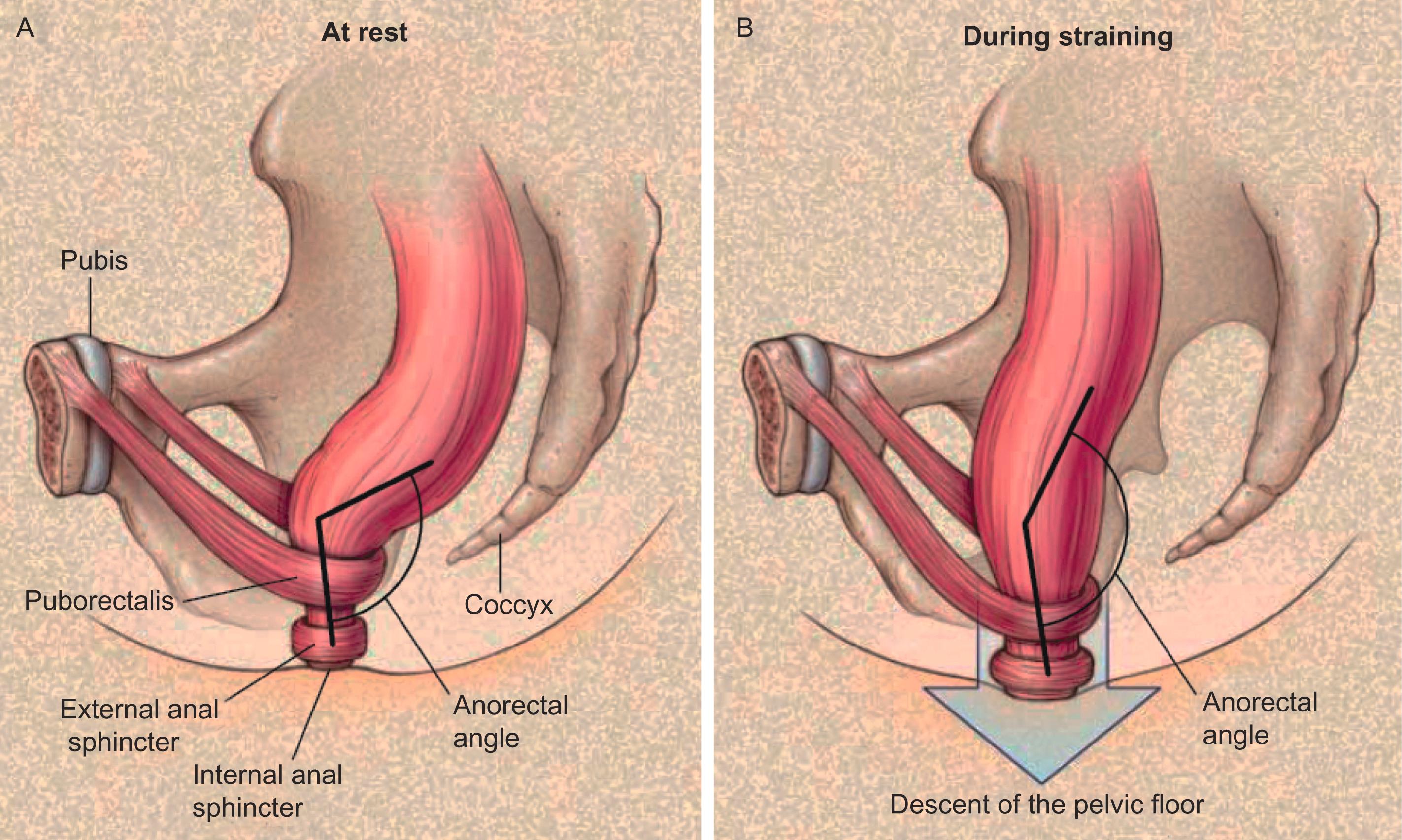 Figure 14-4, Schema showing pelvic floor, rectoanal angle, and sphincters at rest ( A ) and normal alterations during defecation ( B ).