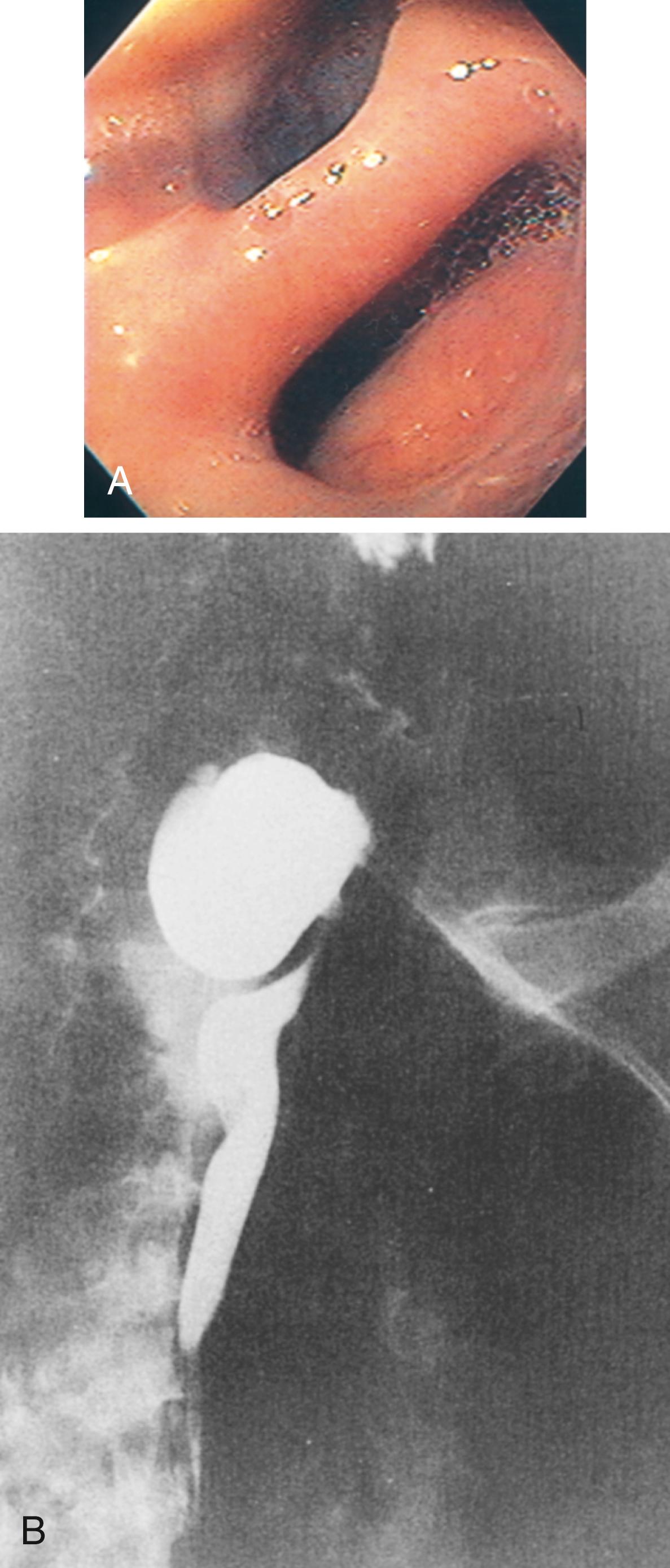 Fig. 26.1, Zenker diverticulum.