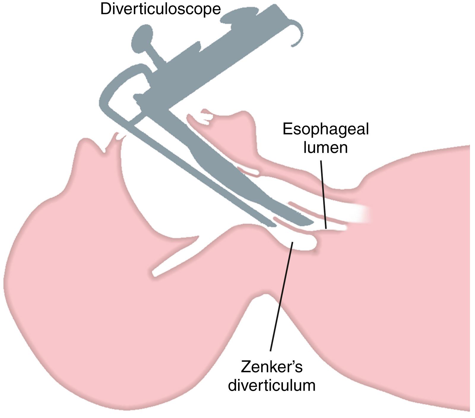 Fig. 26.2, Diverticuloscope. The instrument is positioned to expose the common wall between the lumen of the esophagus and the Zenker diverticulum.