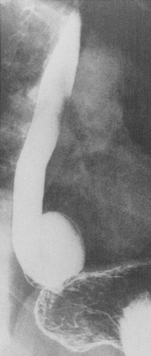 Fig. 26.4, Barium esophagogram showing an epiphrenic diverticulum immediately above the stomach. In this projection, the diverticulum may be confused with a hiatal hernia.