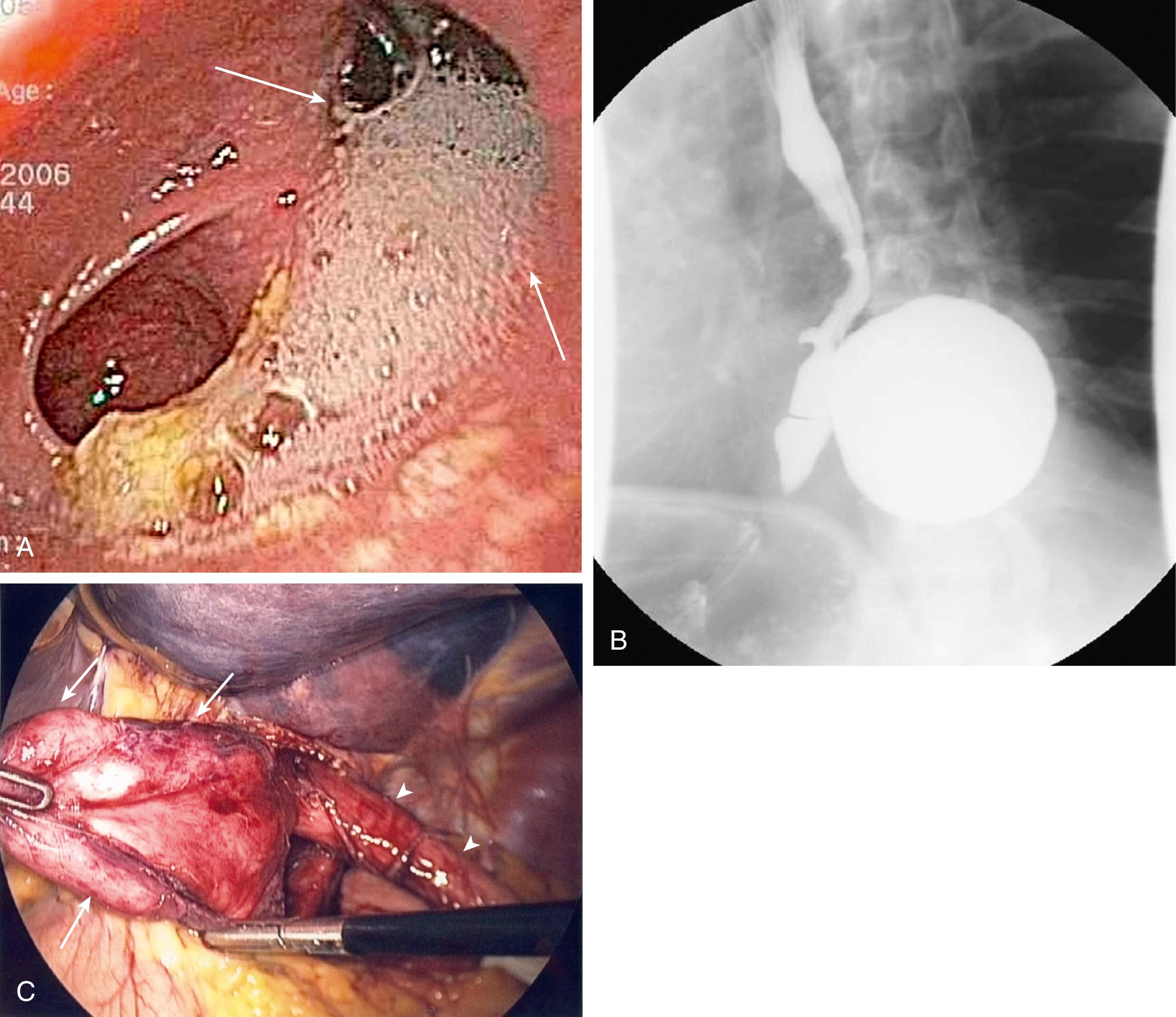 Fig. 26.5, Giant esophageal diverticulum. A, Endoscopic view of a large esophageal diverticulum with food and liquid ( arrows ). B, Barium esophagogram showing a large esophageal diverticulum. C, Laparoscopic resection of a large diverticulum ( arrows ) of the esophagus ( arrowheads ).