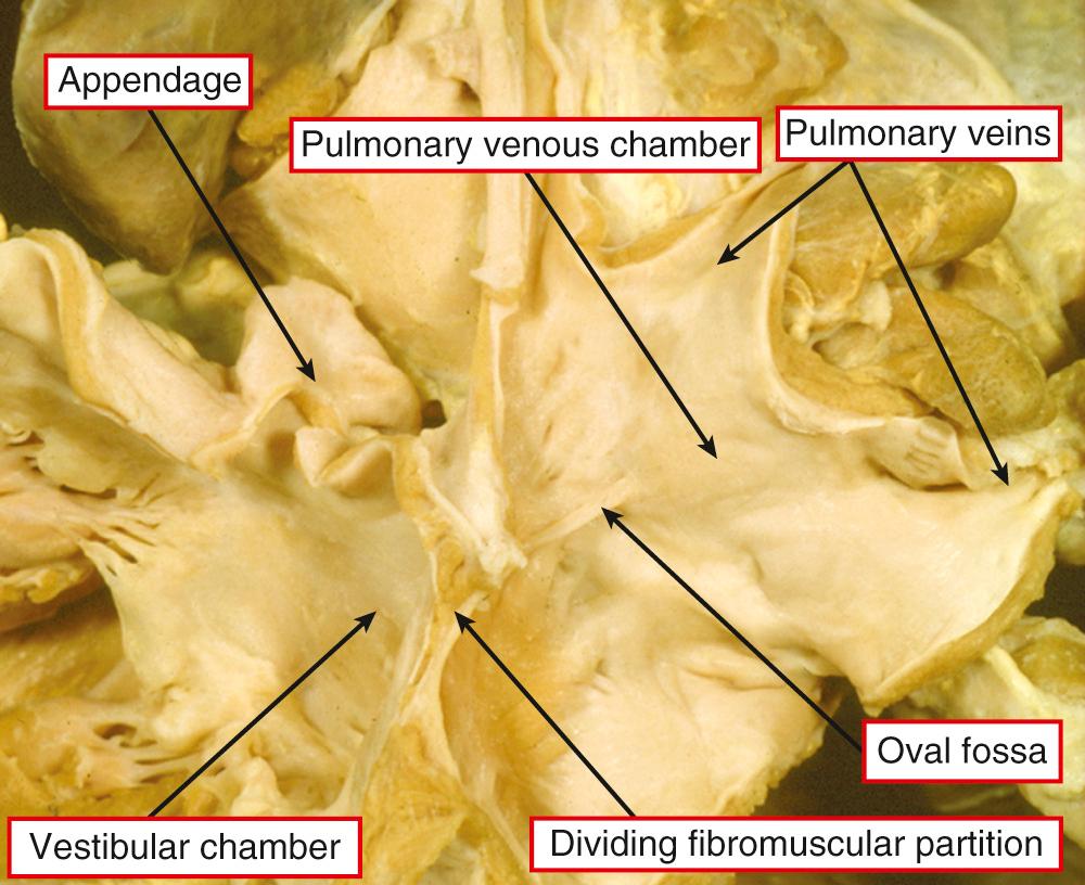 Fig. 30.1, Heart with division of the left atrium, photographed from the left side. The partition divides the chamber into a pulmonary venous component, which contains the left atrial aspect of the oval fossa and a vestibular component, which includes the left atrial appendage.