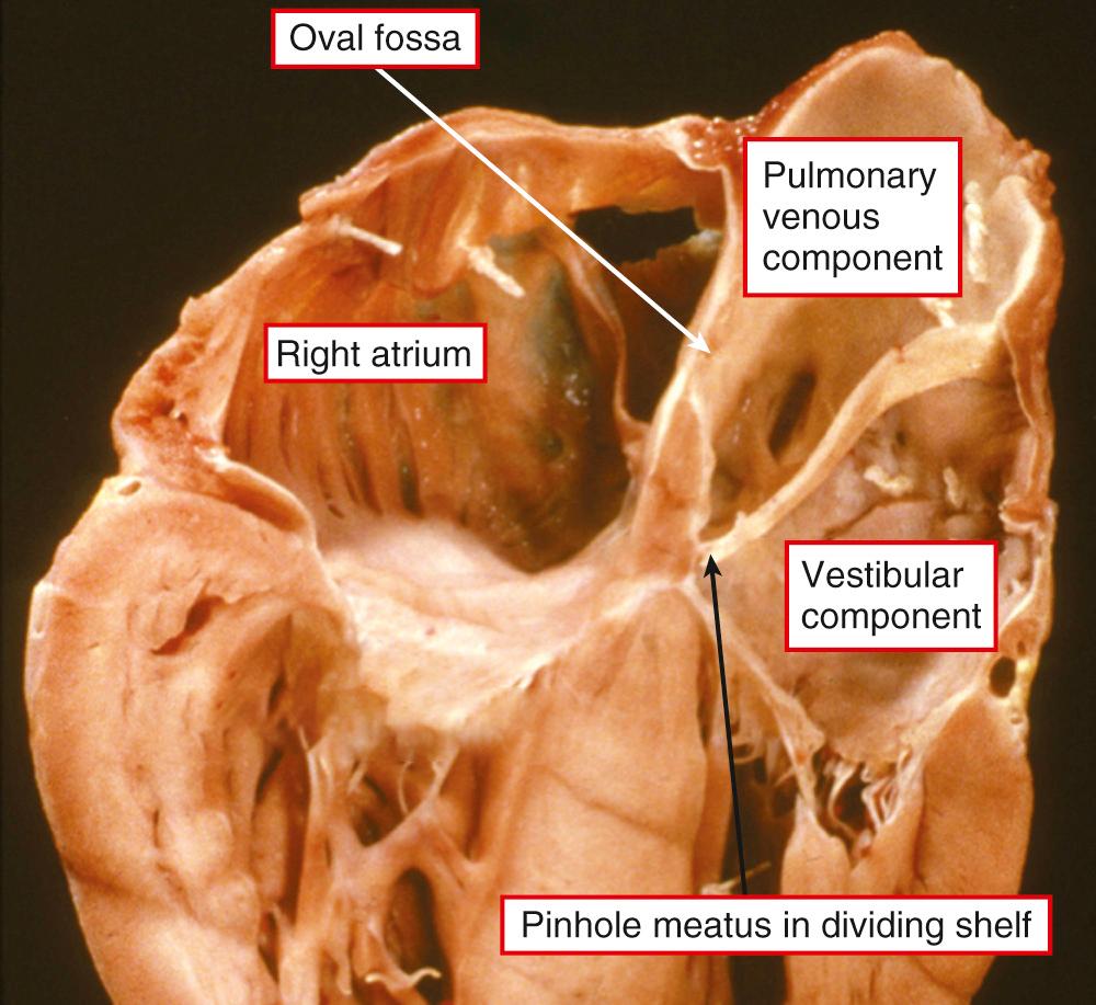 Fig. 30.2, Heart shown in Fig. 30.1 reconstituted and sectioned to replicate the echocardiographic four-chamber view. Note the oblique dividing shelf, with only a pinhole meatus between the two components of the divided left atrium. Note also that the oval fossa opens to the pulmonary venous component.