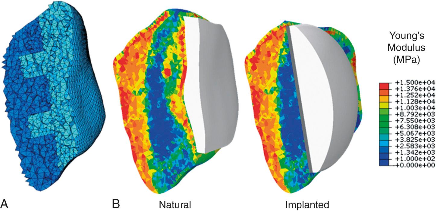 FIG 22.1, (A) Tetrahedral mesh of patellar bone for natural (both light and dark elements) and implanted (dark elements only) models. (B) Patellar bone with mapped material properties in natural and implanted models.