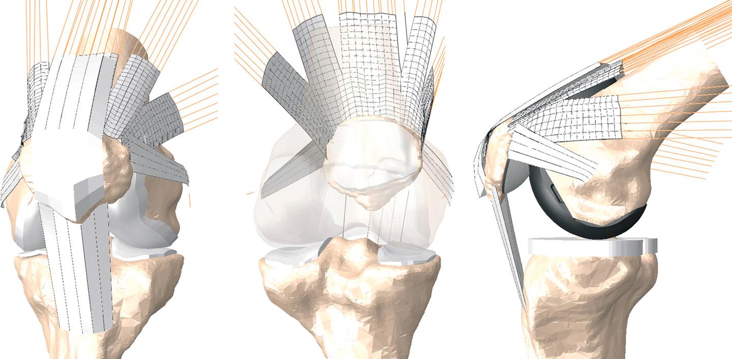 FIG 22.2, Anterior view of the natural PF model, including vasti, rectus femoris, patellar ligament, and PF constraint structures (left) ; posterior view of the natural PF model shown with transparent femoral bone and cartilage (center) ; and sagittal view of the implanted PF model during flexion.