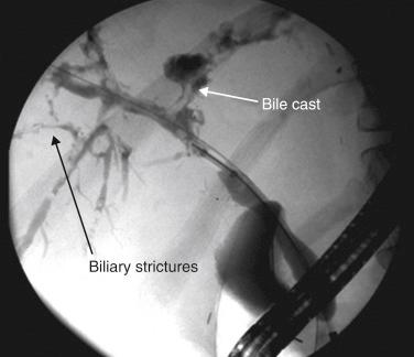 FIGURE 42-2, Endoscopic retrograde cholangiopancreatography depicting ischemic cholangiopathy (bile casts and biliary strictures) in a donation after cardiac death liver transplant recipient.
