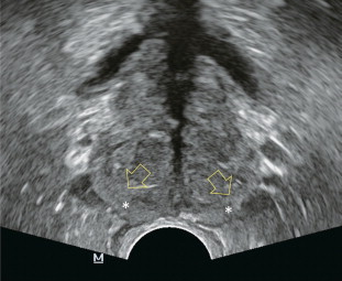 FIGURE 11-1, Axial ultrasound of the prostate in a normal patient. Note peripheral zone (*) separated from the more centrally oriented, periurethral, transition zone by the surgical capsule (open arrows).