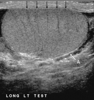 FIGURE 13-2, Longitudinal view of a normal testicle. The testicle is of relatively uniform echogenicity. On this high-resolution image, the testicular septa can be perceived as fine lines dividing the parenchyma into the individual lobules (black arrows). Note the echogenic tunica albuginea surrounding the testicle (A).