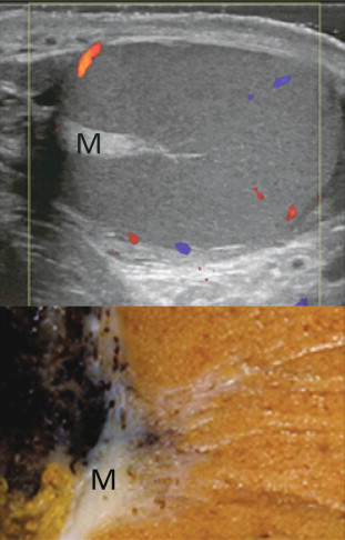 FIGURE 13-3, Transverse view of the left testicle compared to a specimen in the region of the mediastinum testis. The mediastinum testis is an echogenic fibrous structure. It is the point of confluence of the efferent ductules and the septa. Note its triangular echogenic appearance on the ultrasound (M) and how well it correlates with the dense white fibrous stroma on the specimen.