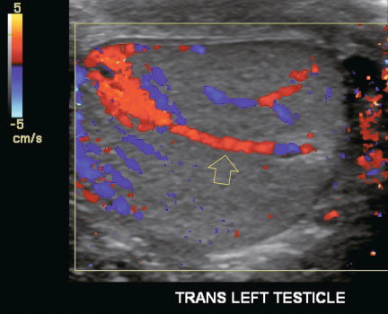 FIGURE 13-7, Longitudinal colour Doppler image of a testicle. A transtesticular artery (open arrow) can be seen coursing obliquely through the testicle along the mediastinum. It is a branch of the testicular artery, but is seen in less than half of normal cases.