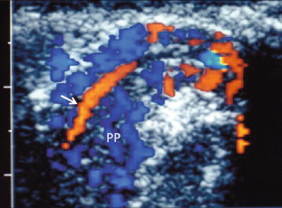 FIGURE 13-8, The pampiniform plexus of veins (PP) is a web-like collection of vessels surround the testicular artery (arrow) as it passes through the spermatic cord.