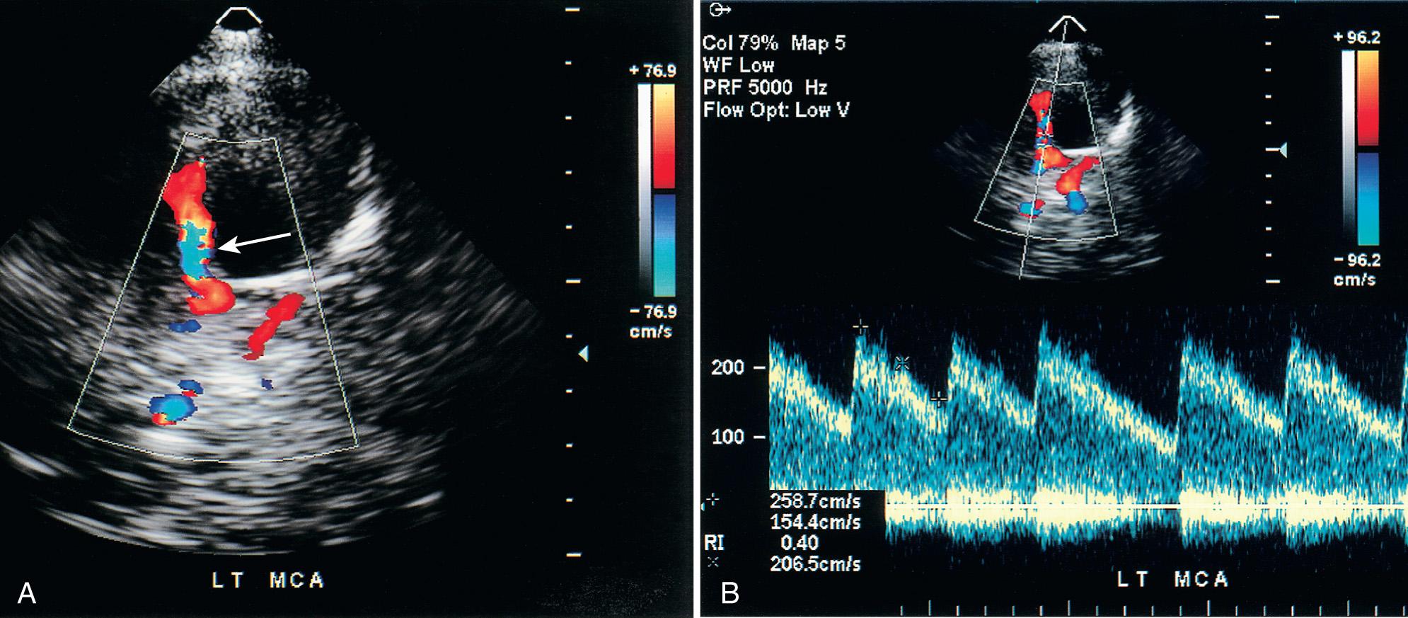 FIG. 47.11, Maximum MCA Velocity Greater Than 200 cm/sec Indicates Cerebrovascular Disease in 4-Year-Old Girl With Sickle Cell Disease.