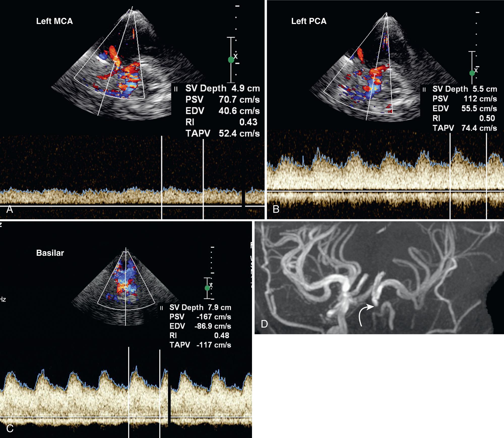 FIG. 47.12, Low Middle Cerebral Artery (MCA) Velocity in 8-Year-Old Child With Sickle Cell Disease.