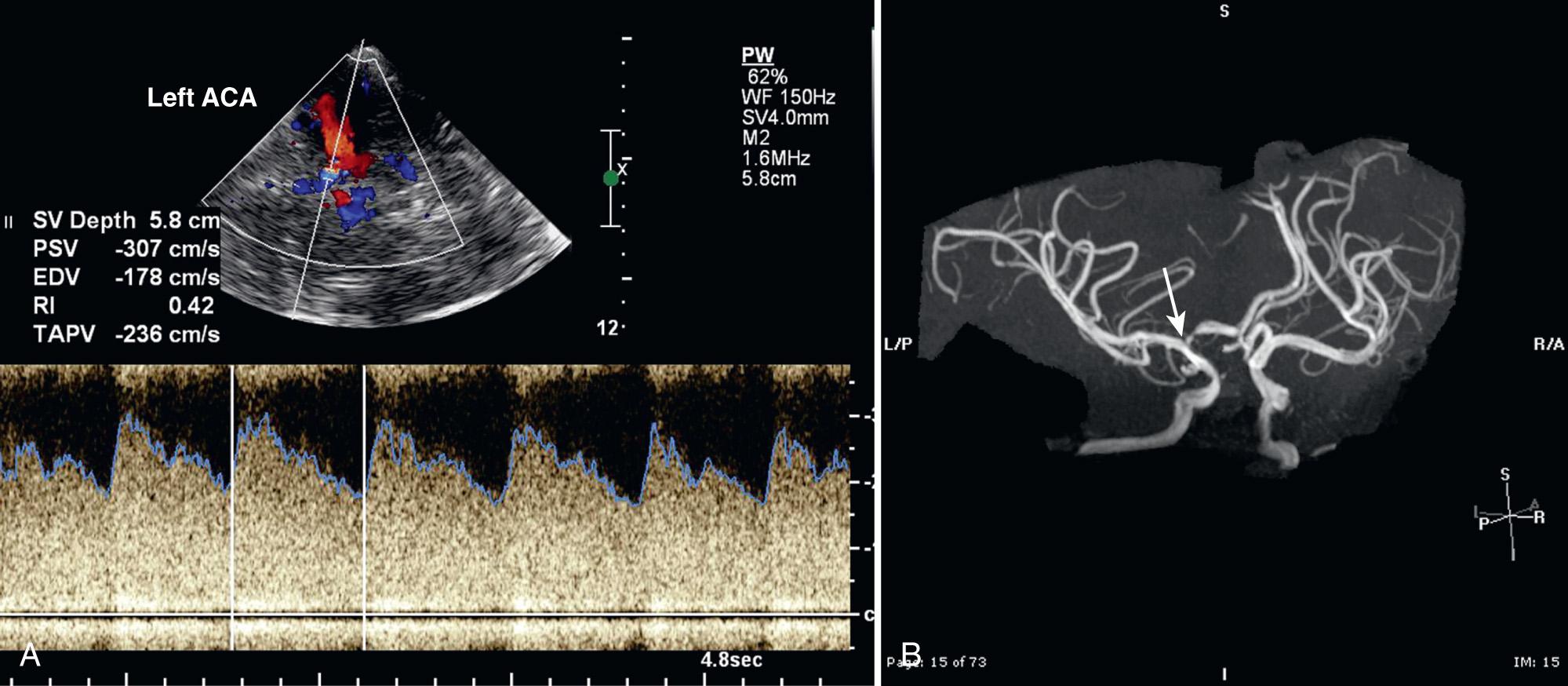 FIG. 47.14, Anterior Cerebral Artery (ACA) Stenosis in 11-Year-Old Child With Sickle Cell Disease.