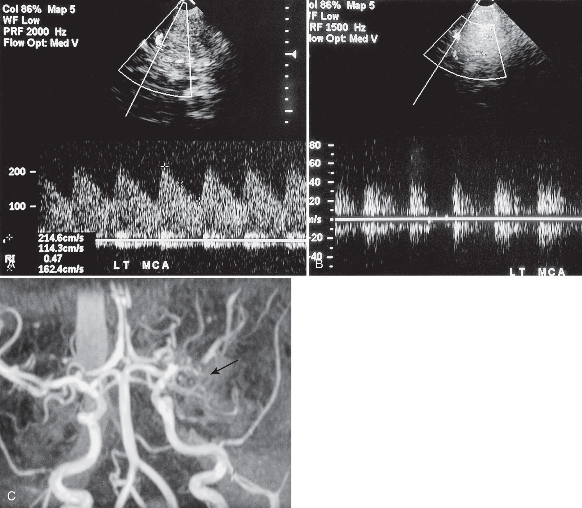 FIG. 47.15, Progression to Moyamoya Angiopathy in -Year-Old Boy With Sickle Cell Disease.