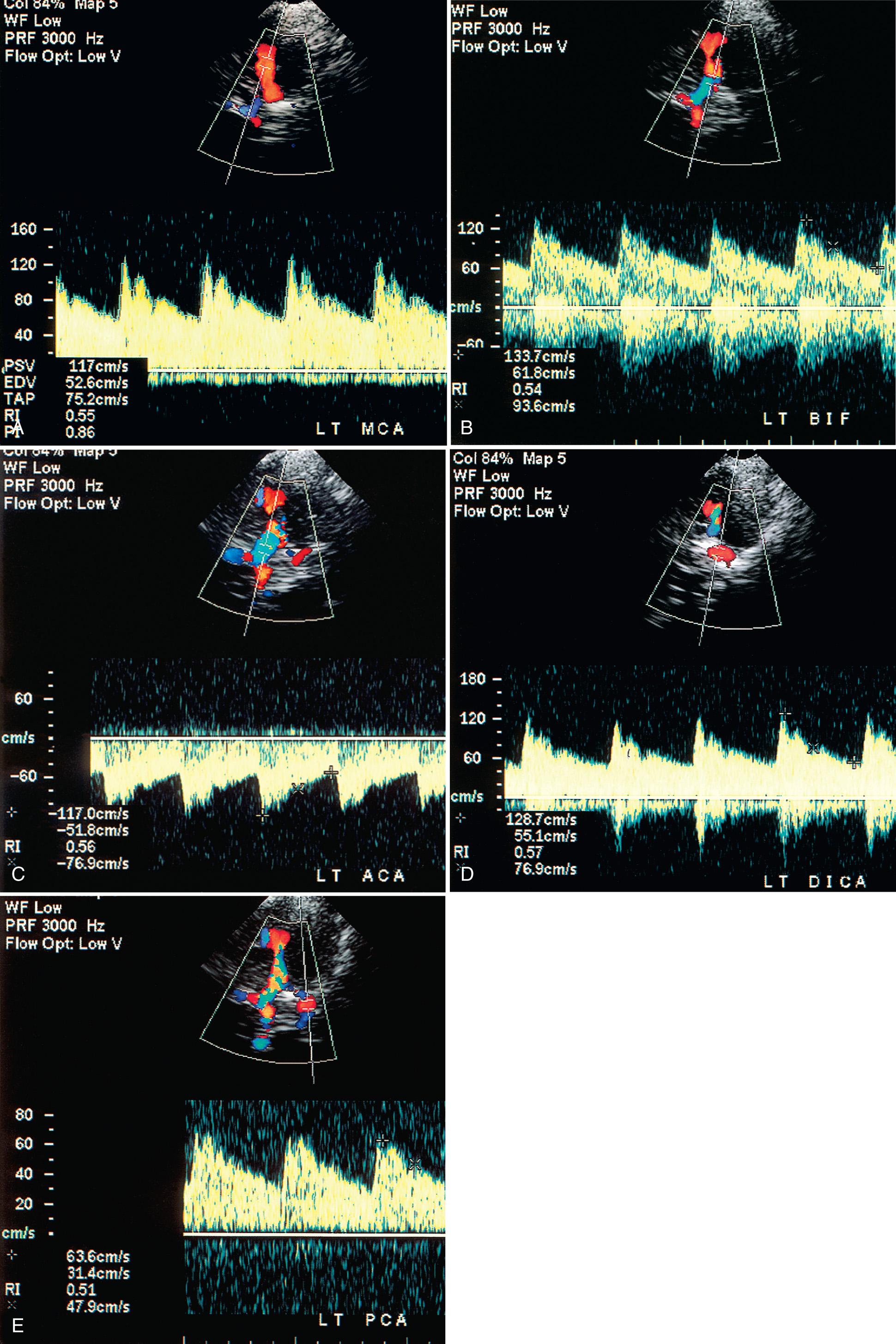 FIG. 47.2, Normal Transtemporal Color Flow Doppler Waveforms.