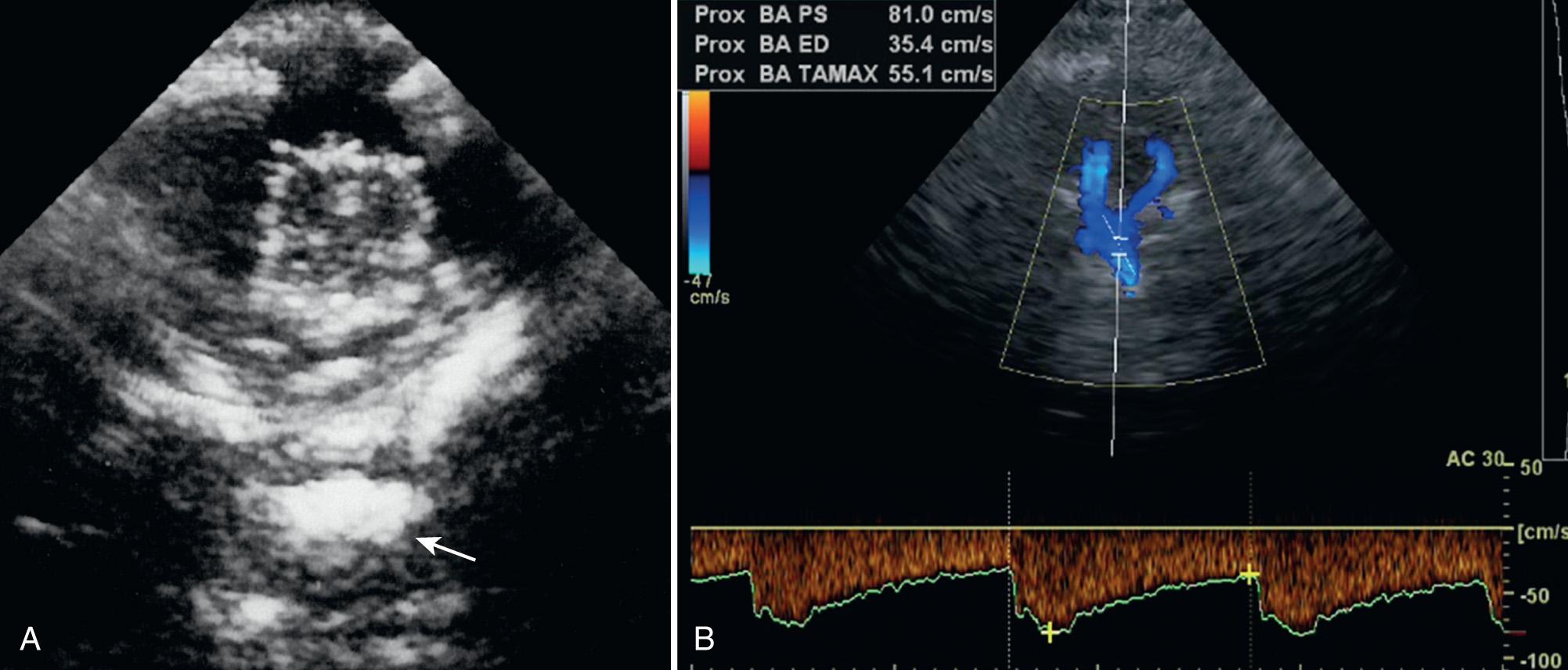 FIG. 47.3, Occipital View Through Foramen Magnum.