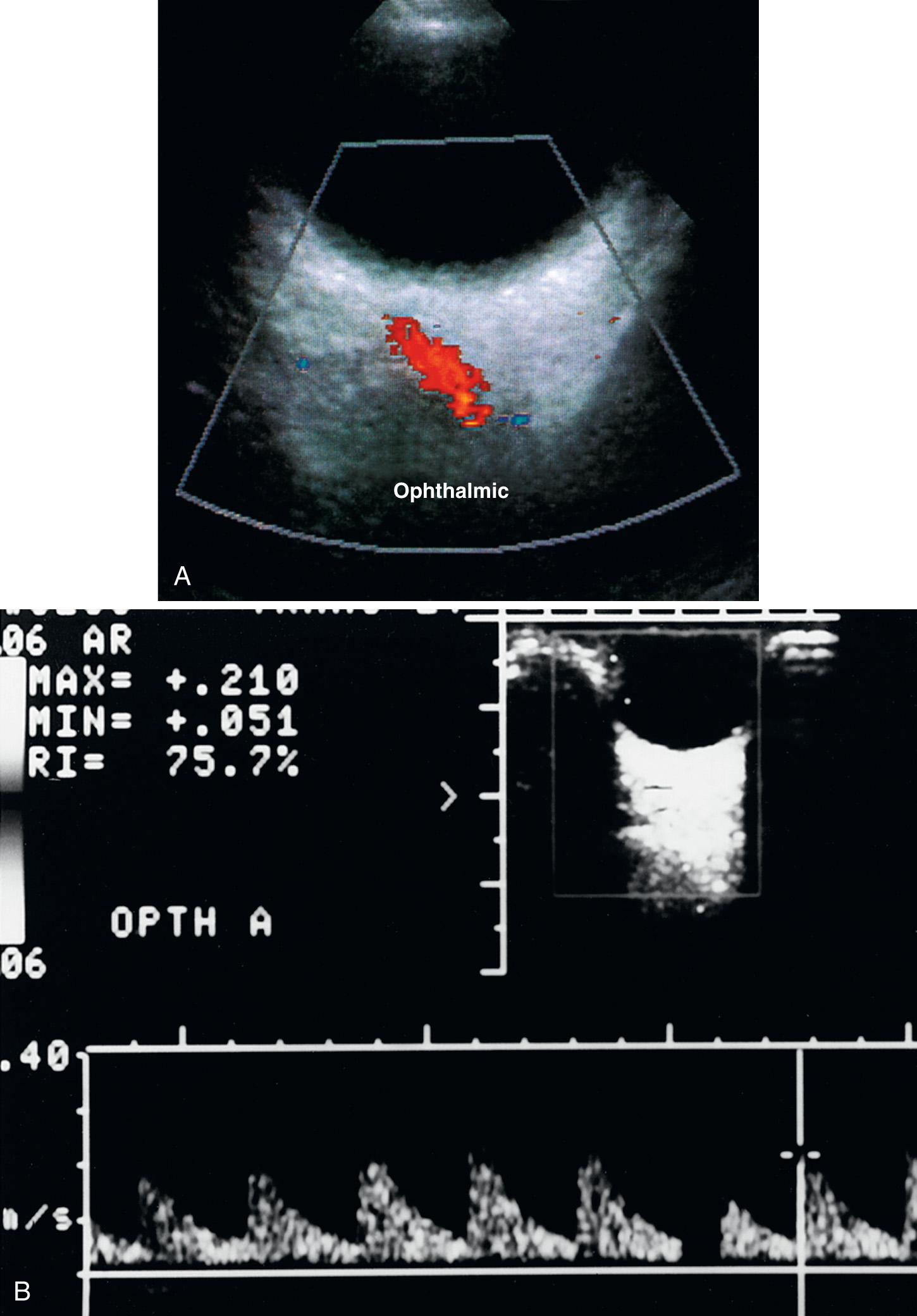 FIG. 47.4, Normal Transcranial Doppler Sonography Through Eye.