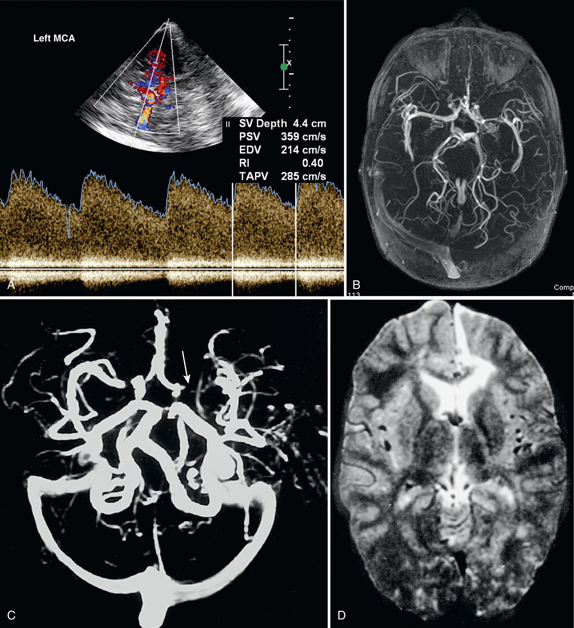 FIG. 47.6, Middle Cerebral Artery (MCA) Stenosis in 9-Year-Old With Sickle Cell Disease.