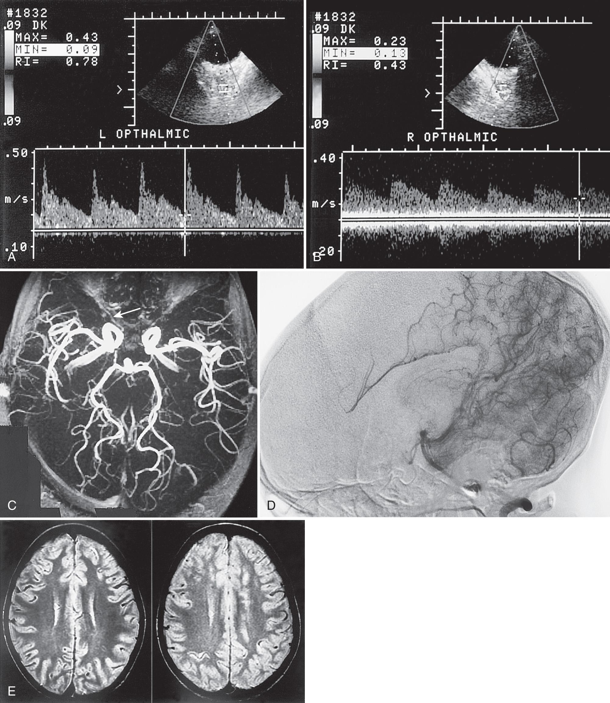 FIG. 47.7, Developing Stroke in Asymptomatic 13-Year-Old Boy With Sickle Cell Anemia.