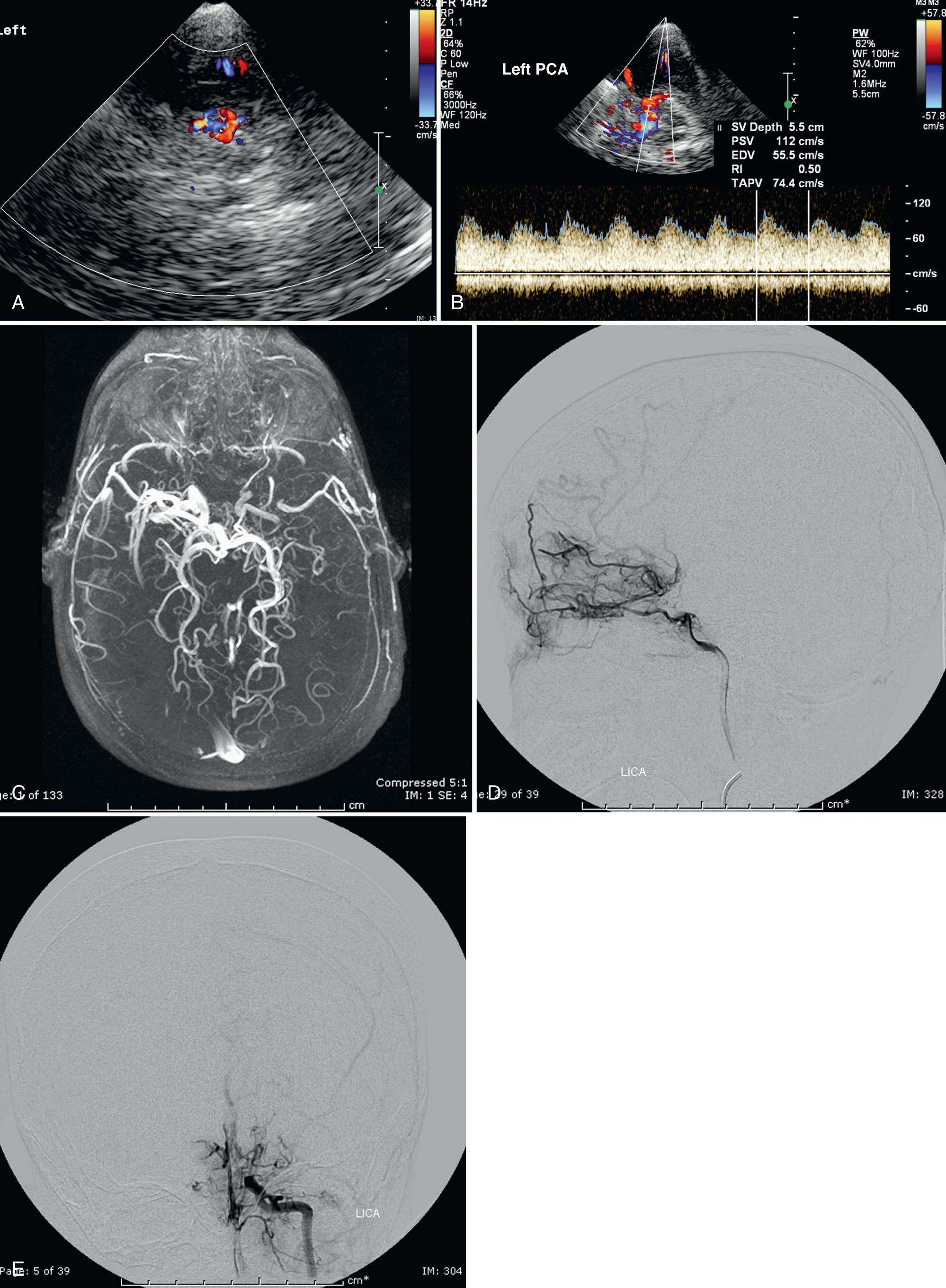 FIG. 47.8, Moyamoya Angiopathy in 8-Year-Old Child With Sickle Cell Disease and History of Left-Sided Stroke.