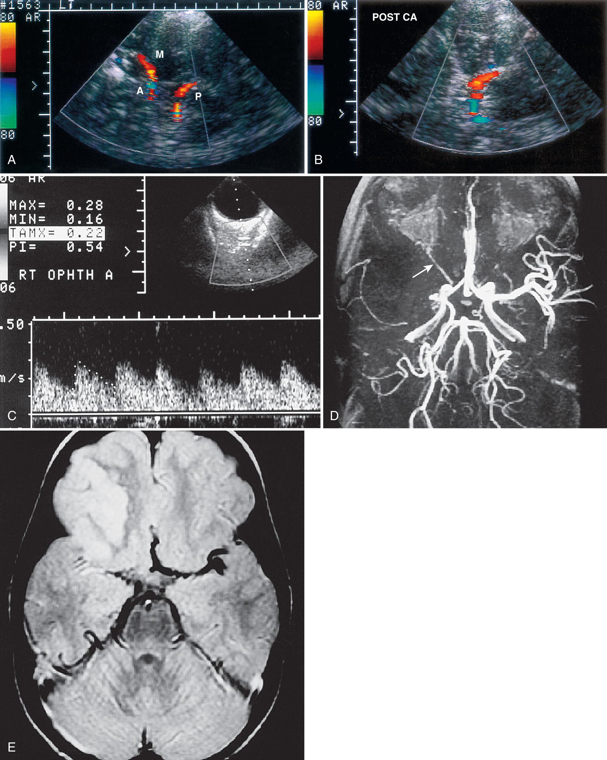 FIG. 47.9, Acute Stroke in 3-Year-Old Boy With Sickle Cell Disease, With Acute Slurred Speech and Left-Sided Weakness.