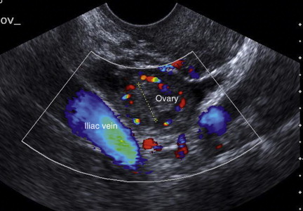 FIGURE 14-1, Vessels lateral to ovary – these help the operator locate the ovary.